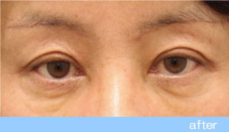 眼瞼下垂の症例5眉毛下皮膚切除法の術後［保険適用］