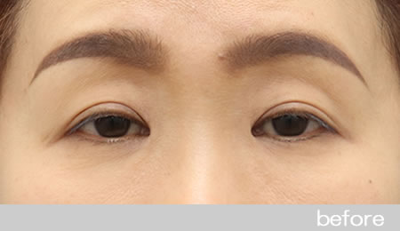 眼瞼下垂の症例8眼瞼挙筋前転法の術前［保険適用］