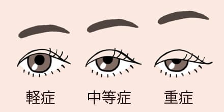 眼瞼下垂の症状の程度
