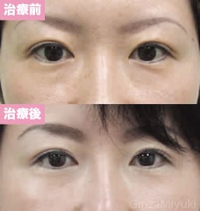 モニター症例№1（32歳 女性）経結膜脱脂