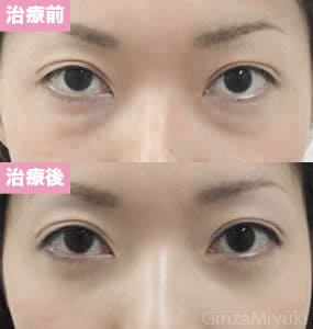 モニター症例№2（31歳 女性）経結膜脱脂