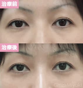 モニター症例№3（29歳 女性）経結膜脱脂