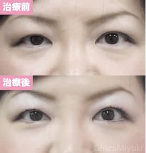 モニター症例№4（36歳 女性）経結膜脱脂