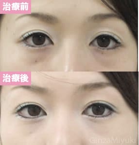 モニター症例№5（26歳 女性）経結膜脱脂