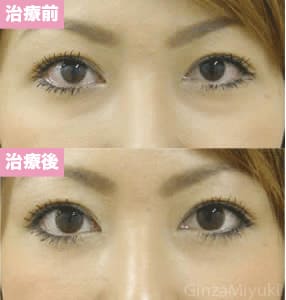 モニター症例№6（28歳 女性）経結膜脱脂