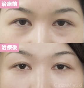 モニター症例№7（30歳 女性）脱脂ダブルリポ