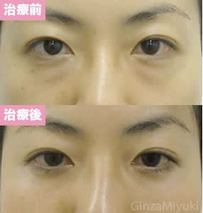 モニター症例№8（30歳 女性）脱脂ダブルリポ