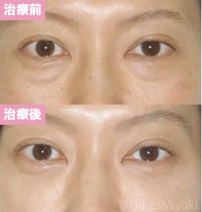 モニター症例№9（41歳 女性）脱脂ダブルリポ