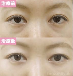 モニター症例№12（33歳 女性）脱脂ダブルリポ