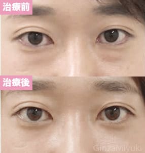 モニター症例№13（27歳 女性）脱脂ダブルリポ