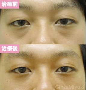 モニター症例№15（24歳 男性）脱脂ダブルリポ