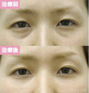 モニター症例№16（31歳 女性）脱脂ダブルリポ