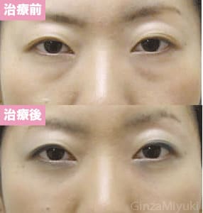 モニター症例№18（29歳 女性）脱脂ダブルリポ