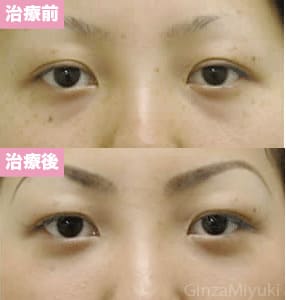 モニター症例№19（22歳 女性）脱脂ダブルリポ