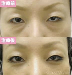 モニター症例№20（34歳 女性）脱脂ダブルリポ