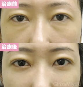 モニター症例№21（34歳 女性）脱脂ダブルリポ