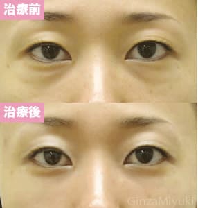 モニター症例№22（31歳 女性）脱脂ダブルリポ