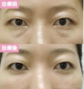 モニター症例№23（34歳 女性）脱脂ダブルリポ