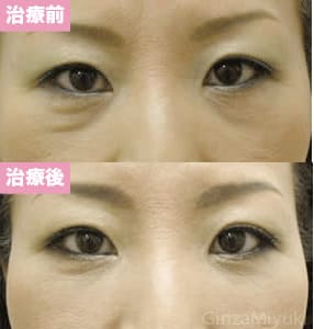 モニター症例№24（47歳 女性）脱脂ダブルリポ