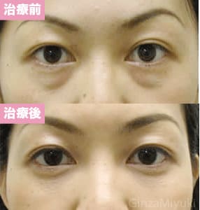 モニター症例№25（35歳 女性）脱脂ダブルリポ