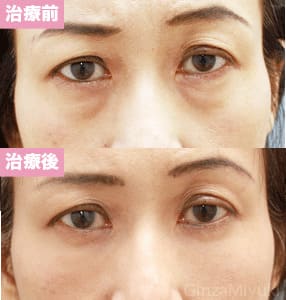 モニター症例№26（50歳 女性）脱脂ダブルリポ