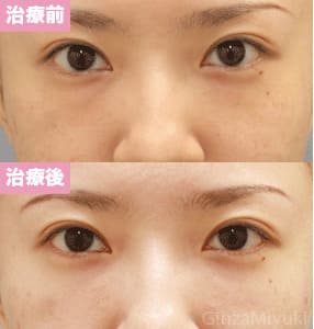 モニター症例№27（27歳 女性）脱脂ダブルリポ