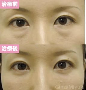 モニター症例№28（39歳 女性）脱脂ダブルリポ