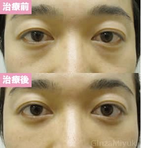 モニター症例№29（31歳 男性）脱脂ダブルリポ