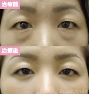 モニター症例№33（36歳 女性）脱脂ダブルリポ