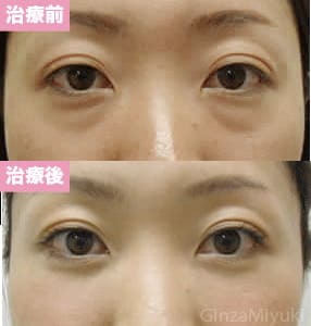 モニター症例№34（32歳 女性）脱脂ダブルリポ