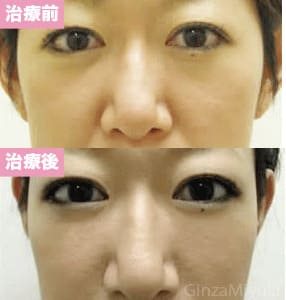 モニター症例№35（41歳 女性）脱脂ダブルリポ