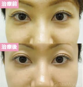 モニター症例№36（28歳 女性）脱脂ダブルリポ