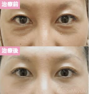 モニター症例№38（46歳 女性）脱脂ダブルリポ