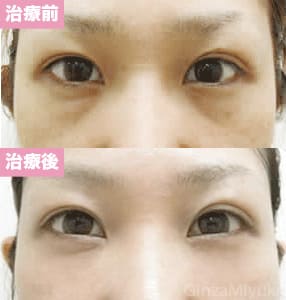 モニター症例№40（27歳 女性）脱脂ダブルリポ