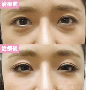 モニター症例№41（41歳 女性）脱脂ダブルリポ