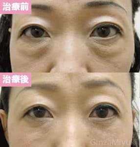 モニター症例№43（46歳 女性）脱脂ダブルリポ