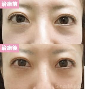 モニター症例№44（38歳 女性）脱脂ダブルリポ