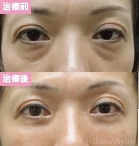 モニター症例№45（39歳 女性）脱脂ダブルリポ