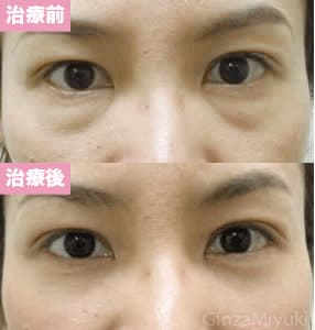 モニター症例№46（34歳 女性）脱脂ダブルリポ