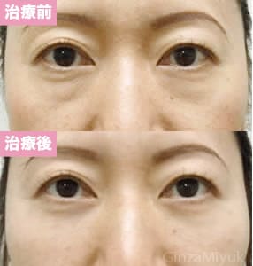 モニター症例№47（女性）脱脂ダブルリポ