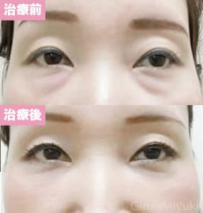 モニター症例№48（39歳 女性）脱脂ダブルリポ