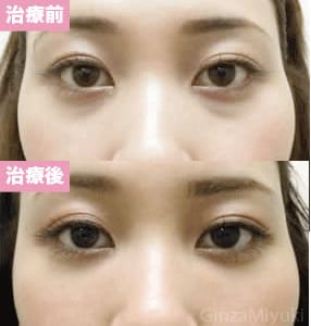 モニター症例№51（25歳 女性）脱脂ダブルリポ