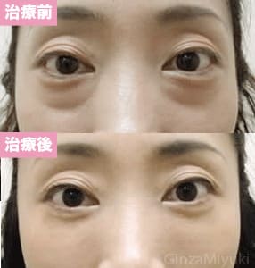 モニター症例№52（44歳 女性）脱脂ダブルリポ