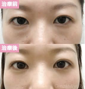 モニター症例№53（34歳 女性）脱脂ダブルリポ