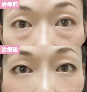 モニター症例№54（37歳 女性）脱脂ダブルリポ