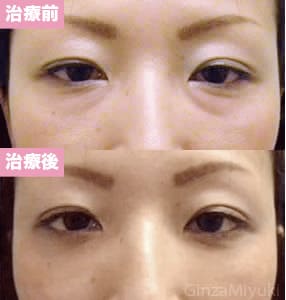 モニター症例№55（35歳 女性）脱脂リポ法