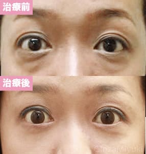 モニター症例№56（41歳 女性）脱脂ダブルリポ