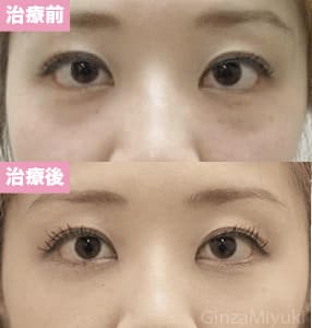 モニター症例№57（30歳 女性）脱脂ダブルリポ