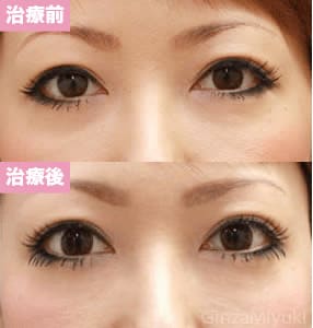 モニター症例№58（32歳 女性）コンデンスリポ法