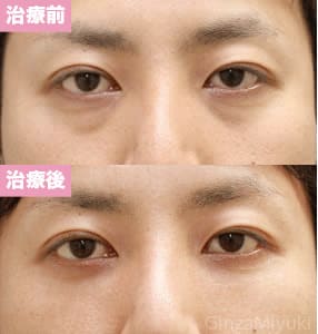 モニター症例№59（34歳 男性）脱脂コンデンスリポ